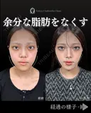 小顔脂肪吸引(頬・あご下・エラ下・ジョールファット)/糸リフト6本 90日後 サムネイル用