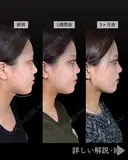小顔脂肪吸引(頬・あご下・エラ下・ジョールファット)/糸リフト6本 before画像 サムネイル用