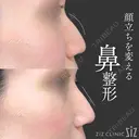 【鼻整形】顔立ちを変える after画像 サムネイル用