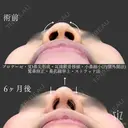 【鼻整形】顔立ちを変える before画像 サムネイル用