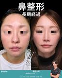 クローズド法による鼻尖形成 730日後 サムネイル用