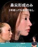 クローズド法による鼻尖形成 730日後 サムネイル用