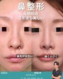 クローズド法による鼻尖形成 730日後 サムネイル用