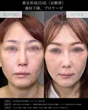 【鼻フル整形】鼻尖形成3D法＋耳介軟骨移植＋鼻柱下降＋プロテーゼ after画像 サムネイル用