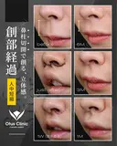 人中短縮（鼻柱切開）/ 貴族組織移植 before画像 サムネイル用