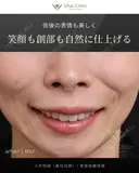 人中短縮（鼻柱切開）/ 貴族組織移植 before画像 サムネイル用