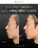 ヒアルロン酸注入（顎） before画像 サムネイル用