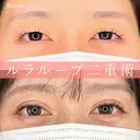 1Dayルラループ二重術 after画像 サムネイル用