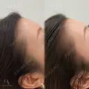 ヘアラインアートメイク before画像 サムネイル用