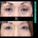 眉下リフト＋切開式眼瞼下垂 before画像 サムネイル用