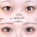 アリエルクイックループトリプル二重埋没法 before画像 サムネイル用