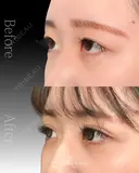 二重埋没法 before画像 サムネイル用