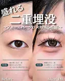 【二重埋没法】フォーエバークロス特殊5点留め before画像 サムネイル用