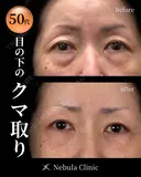 🐻DR都築🐻切らないクマ取り before画像 サムネイル用