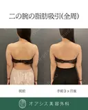カリカリボディを目指す🌴コンプリート脂肪吸引【上腕全周～お背中一部】形成外科専門医がご対応 after画像 サムネイル用