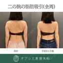 カリカリボディを目指す🌴コンプリート脂肪吸引【上腕全周～お背中一部】形成外科専門医がご対応 after画像 サムネイル用