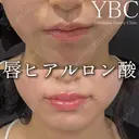 【💄唇ヒアルロン酸💄】 before画像 サムネイル用