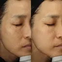 ルメッカ before画像 サムネイル用