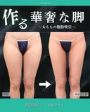 華奢な脚に👠✨ after画像 サムネイル用