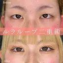 1Dayルラループ二重術 before画像 サムネイル用