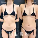 脂肪豊胸 after画像 サムネイル用
