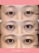 【20代女性】二重術（埋没法）：マイクロメソッド+α（10日後） before画像 サムネイル用