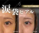 涙袋ヒアルロン酸 before画像 サムネイル用