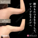 脂肪吸引 30日後 サムネイル用