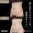脂肪吸引 before画像 サムネイル用