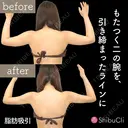 脂肪吸引 30日後 サムネイル用