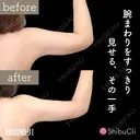 脂肪吸引 before画像 サムネイル用