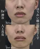貴族手術（人工真皮） after画像 サムネイル用