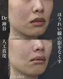 貴族手術（人工真皮） after画像 サムネイル用