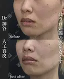 貴族手術（人工真皮） after画像 サムネイル用