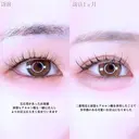 アリエルクイックループトリプル二重埋没法/涙袋ヒアルロン酸 before画像 サムネイル用