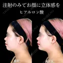 顎ヒアルロン酸 0日後 サムネイル用