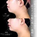 顎ヒアルロン酸 before画像 サムネイル用