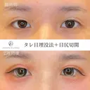 タレ目+目尻切開 14日後 サムネイル用