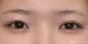 【10代女性・パッチリ二重に】二重全切開術＋脂肪除去（1ヶ月後） 30日後 サムネイル用