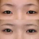 【10代女性・パッチリ二重に】二重全切開術＋脂肪除去（1ヶ月後） 30日後 サムネイル用