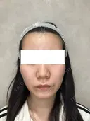 毛穴・クレーターまとめて改善｜トライフィルプロ症例 before画像 サムネイル用