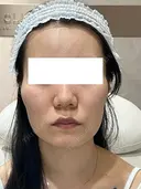 毛穴・クレーターまとめて改善｜トライフィルプロ症例 60日後 サムネイル用