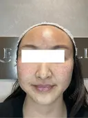 凹凸肌を均一に｜トライフィルプロで肌再生ケア before画像 サムネイル用