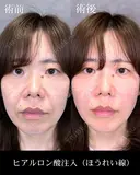 ヒアルロン酸注入（ほうれい線） after画像 サムネイル用