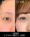 二重埋没/ヒアルロン酸注入（涙袋） before画像 サムネイル用