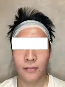 ニキビ跡・毛穴に集中アプローチ｜トライフィルプロでなめらか肌へ before画像 サムネイル用