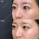 目の下のくまとり（プラチナ） after画像 サムネイル用