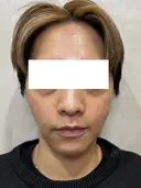 毛穴・皮脂ケアに｜ブラックピールでつるん肌へ before画像 サムネイル用
