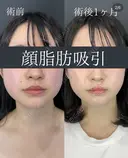 顔脂肪吸引(ホホ下+フェイスライン+アゴ下+エラ下+首側面+首前面) after画像 サムネイル用