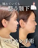 ペリカン手術 before画像 サムネイル用